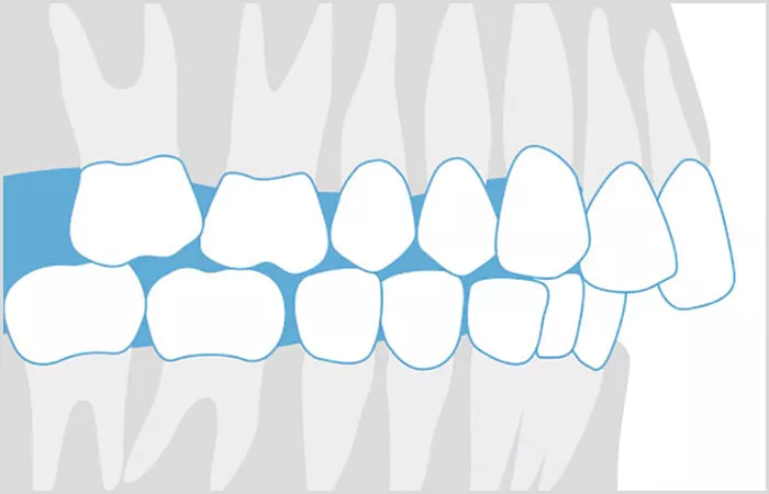 Grafik Überbiss | Kieferorthopäde Dr. Dipsche und Kollegen