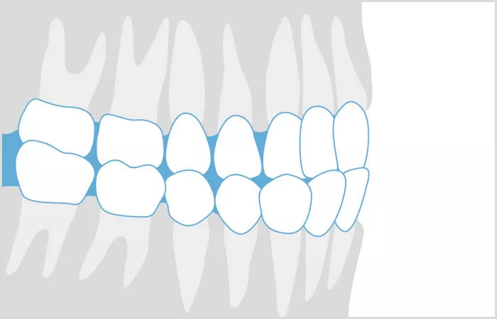 Grafik Kreuzbiss | Kieferorthopäde Dr. Dipsche und Kollegen