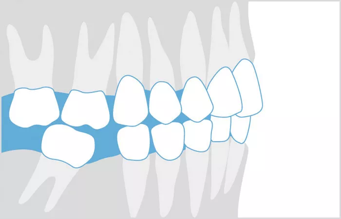 Grafik Zahnfehlstellung | Kieferorthopäde Dr. Dipsche und Kollegen