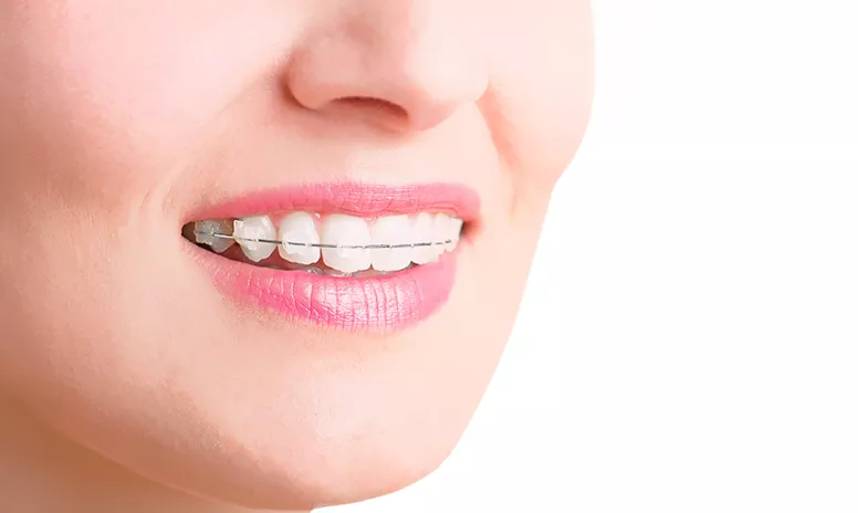 Zähne mit festsitzender Zahnspange und Keramikbrackets