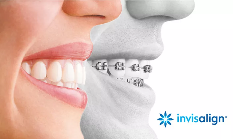 Zähne mit Invisalign Aligner versus Zähne mit fester Zahnspange