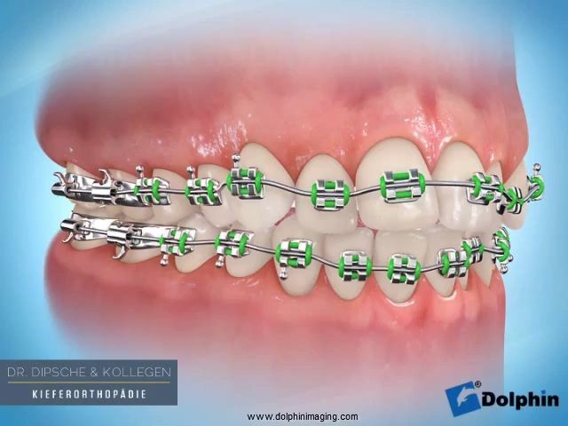 Wie funktioniert ein Bracket?