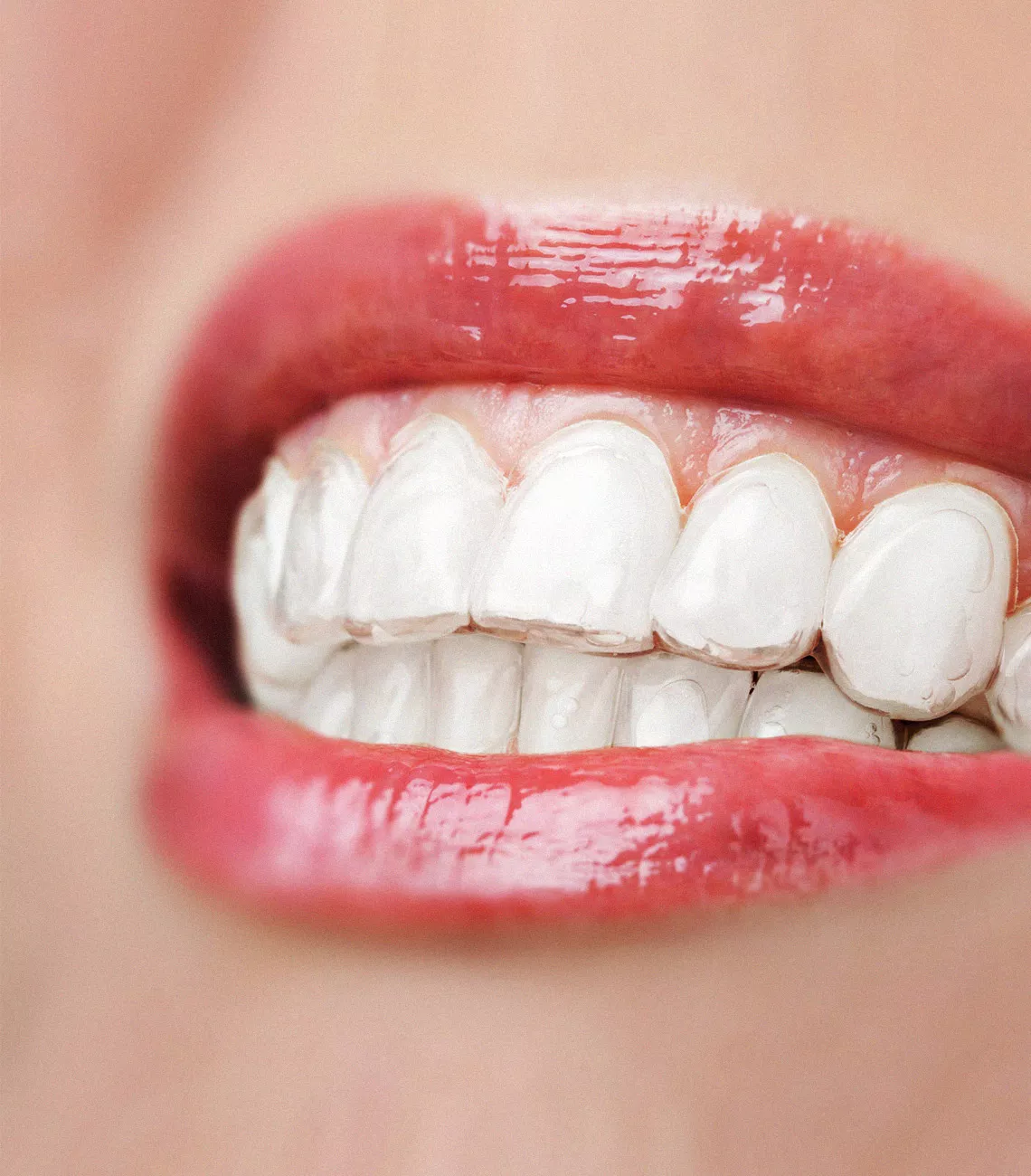 Zähne mit Aligner Zahnschiene